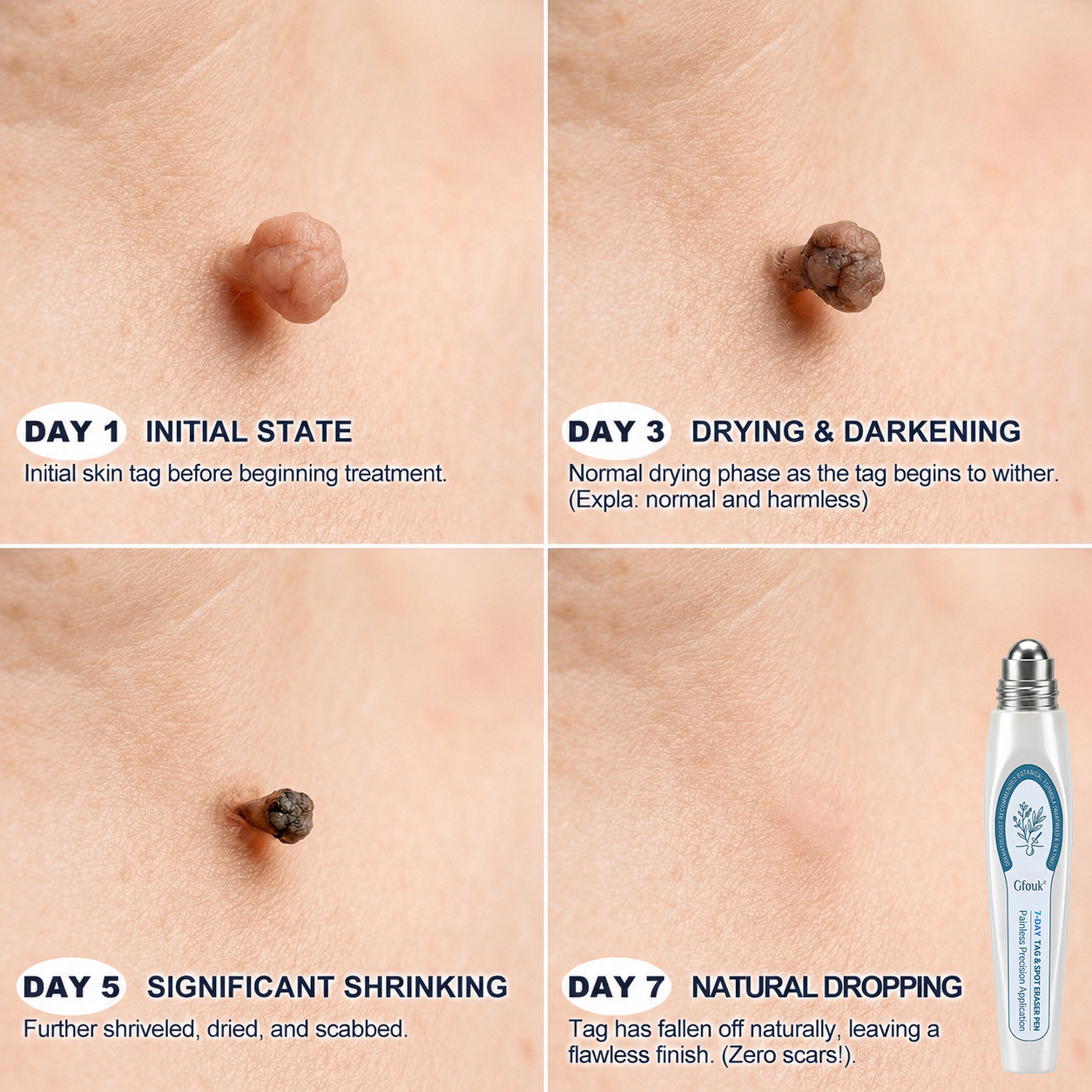 𝐎𝐟𝐟𝐢𝐜𝐢𝐚𝐥 𝐁𝐫𝐚𝐧𝐝 𝐒𝐭𝐨𝐫𝐞 |✒️GFOUK® Fast-Acting Wart Remover Care Pen | Targets Warts, Skin Tags & Rough Bumps(Zero Pain, Zero Scars Rollerball)