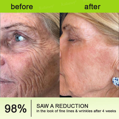 ➡💙💙👨‍⚕️Rolimey®  Vita-A Retinol Shot Wrinkle-Lift Tightening cream