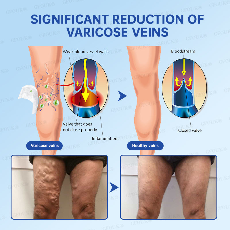 ✅GFOUK® VeinRelief Microneedle Patch ⚡Instant Relief