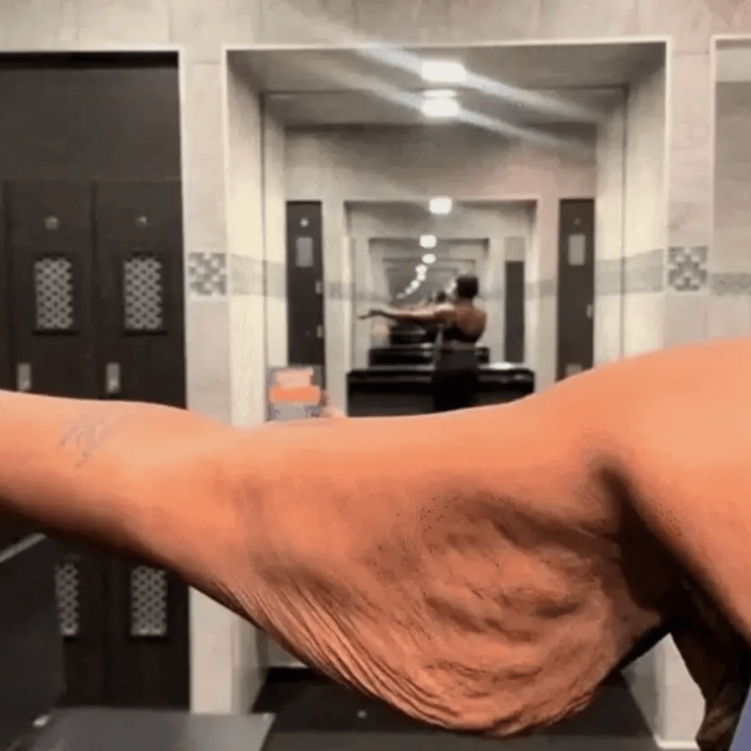 Animated arm sagging skin concern
