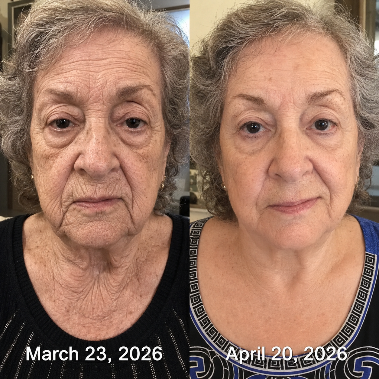 Before and after showing smoother-looking mature facial skin
