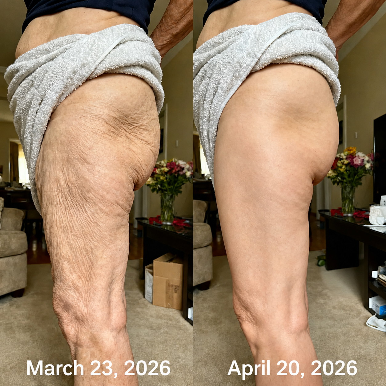 Before and after showing smoother-looking thigh texture
